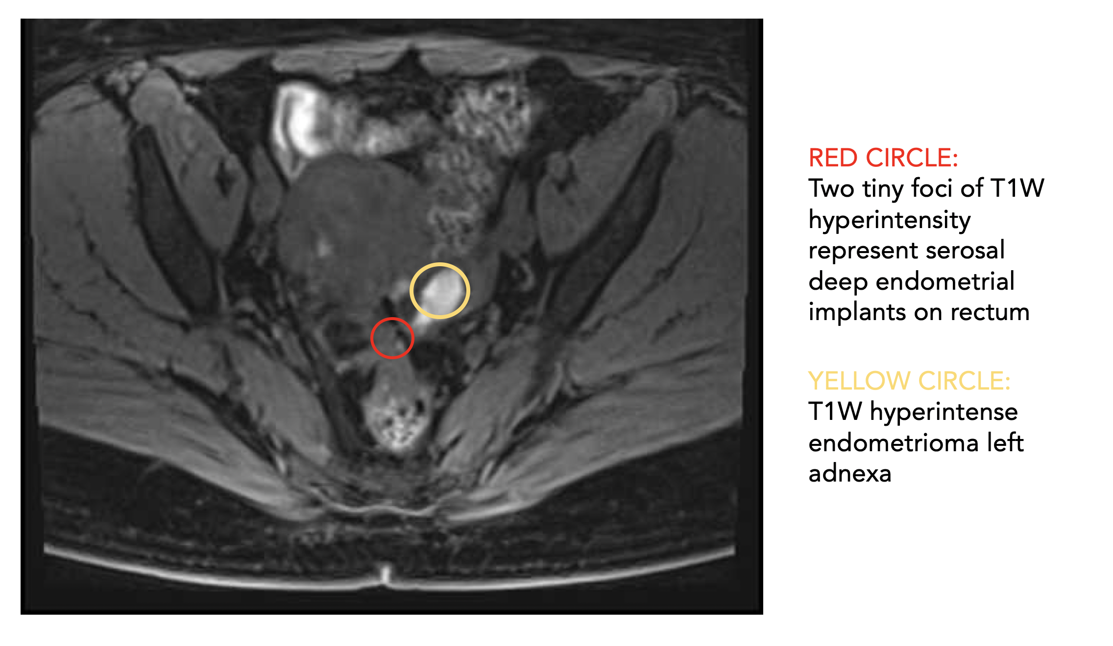 Endometriosis Getting Answers With Mri 0740